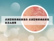 点滴型银屑病皮肤变白 点滴型银屑病皮肤变白怎么回事