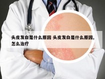 头皮发白是什么原因 头皮发白是什么原因,怎么治疗