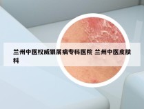 兰州中医权威银屑病专科医院 兰州中医皮肤科