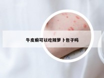 牛皮癣可以吃辣萝卜包子吗