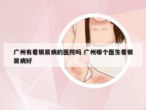 广州有看银屑病的医院吗 广州哪个医生看银屑病好