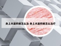 身上大面积癣怎么治 身上大面积癣怎么治疗