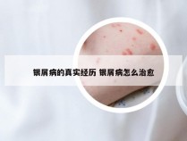 银屑病的真实经历 银屑病怎么治愈