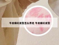 牛皮癣红皮型怎么界定 牛皮廨红皮型