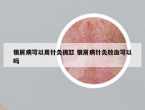 银屑病可以用针灸拔缸 银屑病针灸放血可以吗