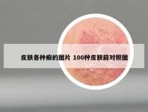 皮肤各种癣的图片 100种皮肤藓对照图