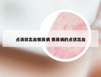 点滴状出血银屑病 银屑病的点状出血