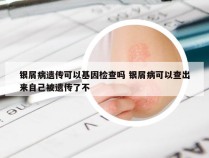 银屑病遗传可以基因检查吗 银屑病可以查出来自己被遗传了不