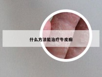 什么方法能治疗牛皮癣