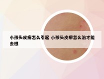 小孩头皮癣怎么引起 小孩头皮癣怎么治才能去根