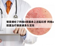 银屑病吃了阿维A胶囊身上还起红疹 阿维a胶囊治疗银屑病多久见效