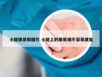 小腿银屑癣图片 小腿上的银屑病不容易康复