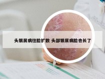 头银屑病往脸扩散 头部银屑病脸也长了