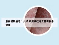 患有银屑病吃什么好 银屑病吃啥食品有利于健康