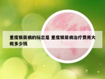 重度银屑病的标志是 重度银屑病治疗费用大概多少钱