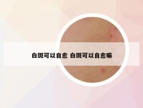 白斑可以自愈 白斑可以自愈嘛