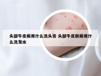 头部牛皮癣用什么洗头膏 头部牛皮肤癣用什么洗发水