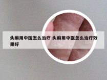 头癣用中医怎么治疗 头癣用中医怎么治疗效果好