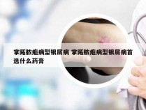 掌跖脓疱病型银屑病 掌跖脓疱病型银屑病首选什么药膏