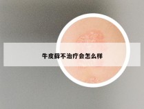 牛皮藓不治疗会怎么样