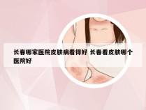 长春哪家医院皮肤病看得好 长春看皮肤哪个医院好