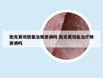 他克莫司胶囊治银屑病吗 他克莫司能治疗银屑病吗