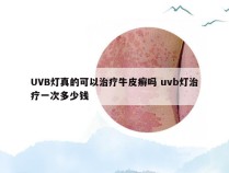 UVB灯真的可以治疗牛皮癣吗 uvb灯治疗一次多少钱