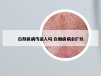 白颠疯病传染人吗 白颠疯病会扩散