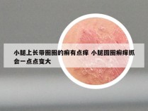 小腿上长带圈圈的癣有点痒 小腿圆圈癣痒抓会一点点变大