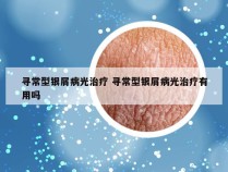 寻常型银屑病光治疗 寻常型银屑病光治疗有用吗