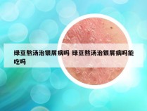 绿豆熬汤治银屑病吗 绿豆熬汤治银屑病吗能吃吗