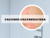 石家庄生物制剂 石家庄生物制剂治疗银屑病