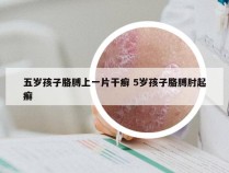 五岁孩子胳膊上一片干癣 5岁孩子胳膊肘起癣