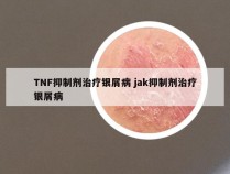 TNF抑制剂治疗银屑病 jak抑制剂治疗银屑病