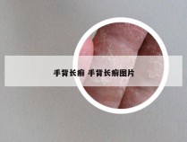 手背长癣 手背长癣图片