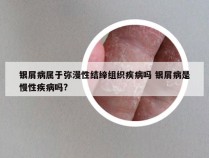 银屑病属于弥漫性结缔组织疾病吗 银屑病是慢性疾病吗?