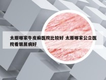 太原哪家牛皮癣医院比较好 太原哪家公立医院看银屑病好