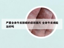 严重全身牛皮肤癣的症状图片 全身牛皮病能治好吗