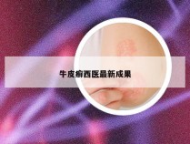 牛皮癣西医最新成果