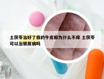 土茯苓治好了我的牛皮癣为什么不痒 土茯苓可以治银屑病吗