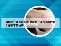 银屑病什么东西能吃 银屑病什么东西能吃什么东西不能吃呢