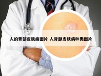 人的背部皮肤癣图片 人背部皮肤病种类图片