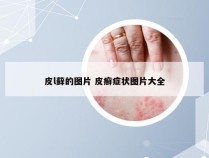 皮l藓的图片 皮癣症状图片大全