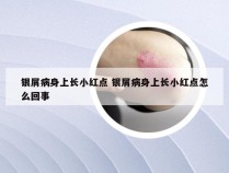 银屑病身上长小红点 银屑病身上长小红点怎么回事