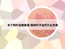 木了树叶治银屑病 银树叶子治疗什么作用