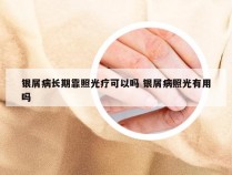 银屑病长期靠照光疗可以吗 银屑病照光有用吗