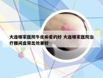 大连哪家医院牛皮癣看的好 大连哪家医院治疗腰间盘突出效果好