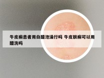 牛皮癣患者用白醋泡澡行吗 牛皮肤癣可以用醋洗吗