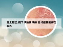 腿上结巴,挠了以后变成癣 腿结疤特别痒怎么办