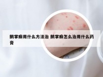 鹅掌癣用什么方法治 鹅掌癣怎么治用什么药膏